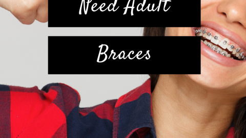 3 Signs You Need Adult Braces